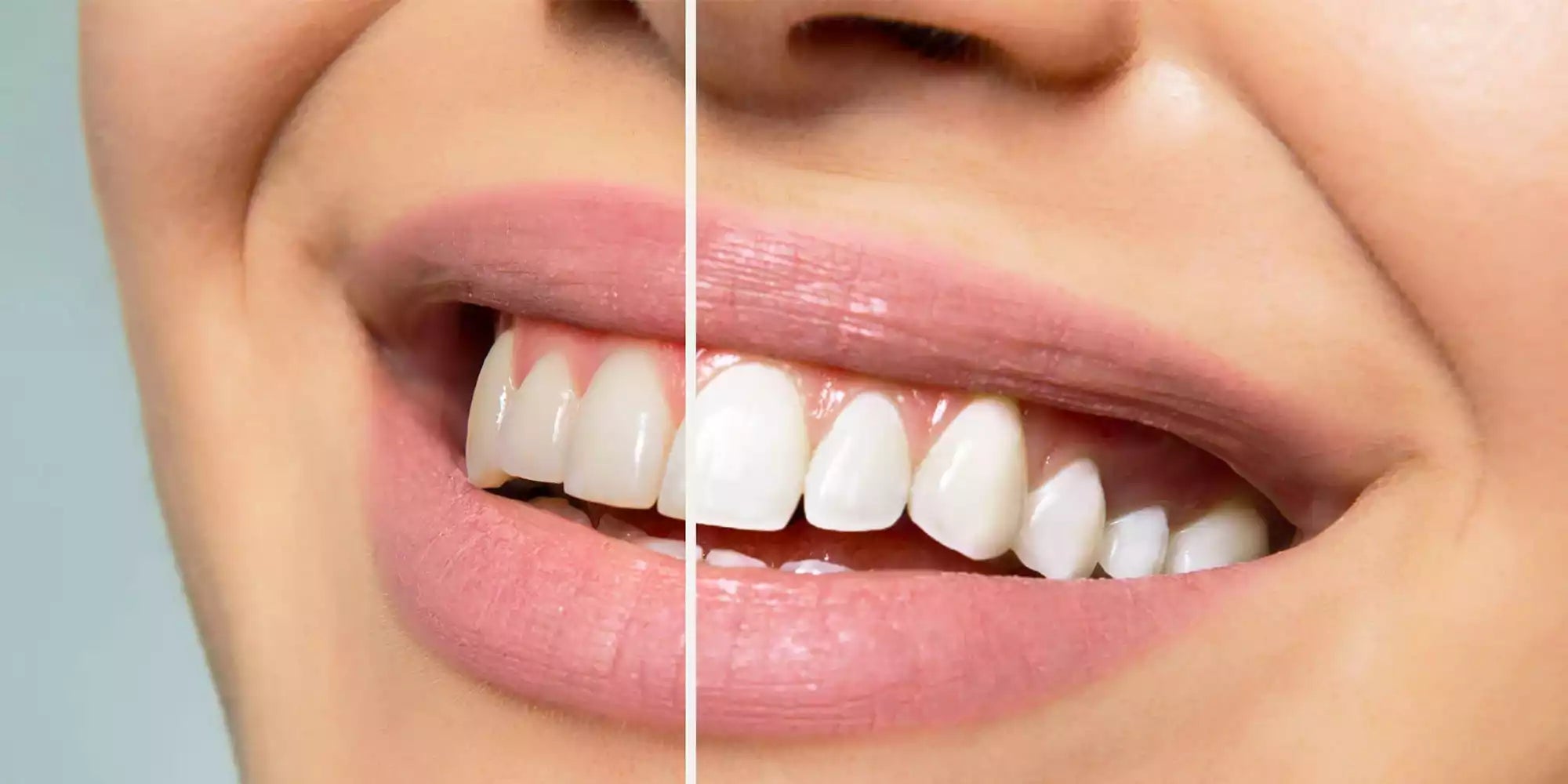 Hydropulseur et tartre dentaire - monhydropulseur.fr